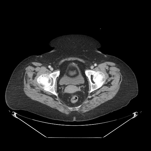 File:Closed loop small bowel obstruction - internal hernia (Radiopaedia 65402-74450 A 126).jpg