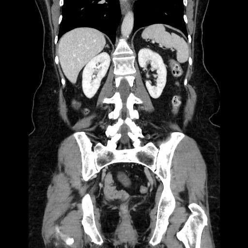 File:Closed loop small bowel obstruction due to adhesive bands - early and late images (Radiopaedia 83830-99015 B 85).jpg