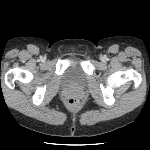 Closed loop small bowel obstruction due to trans-omental herniation (Radiopaedia 35593-37109 A 86).jpg