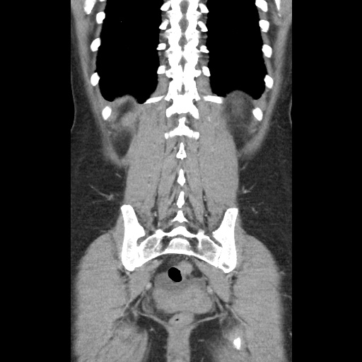 File:Closed loop small bowel obstruction due to trans-omental herniation (Radiopaedia 35593-37109 B 43).jpg