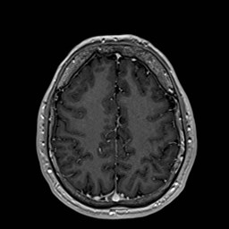 File:Cochlear incomplete partition type III associated with hypothalamic hamartoma (Radiopaedia 88756-105498 Axial T1 C+ 143).jpg