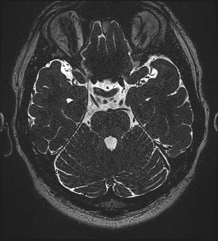 Cochlear incomplete partition type III associated with hypothalamic hamartoma (Radiopaedia 88756-105498 Axial T2 119).jpg