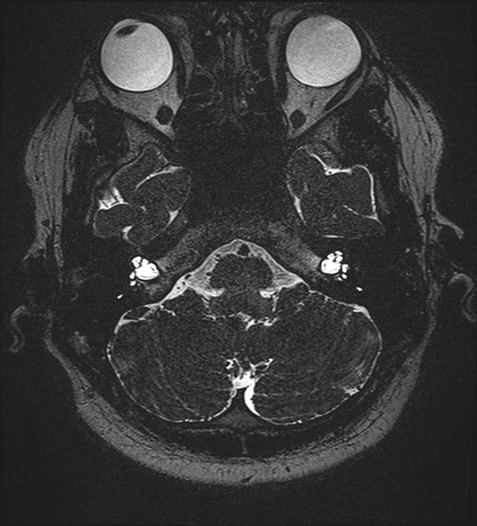 Cochlear incomplete partition type III associated with hypothalamic hamartoma (Radiopaedia 88756-105498 Axial T2 62).jpg