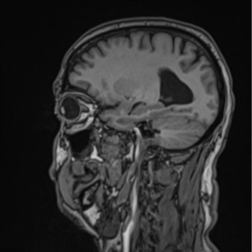File:Colloid cyst of the third ventricle (Radiopaedia 86571-102662 Sagittal T1 25).png
