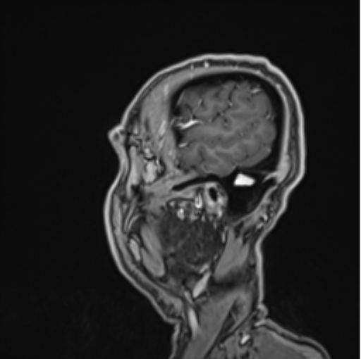 File:Colloid cyst of the third ventricle (Radiopaedia 86571-102662 Sagittal T1 C+ 69).png