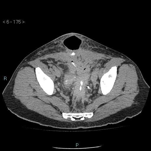 Colo-cutaneous fistula (Radiopaedia 40531-43129 A 73).jpg