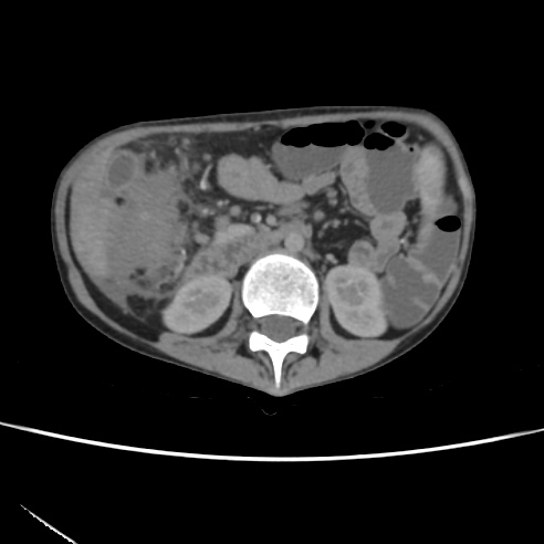 File:Colocolic fistula - Crohn disease (Radiopaedia 57063-63955 A 33).jpg