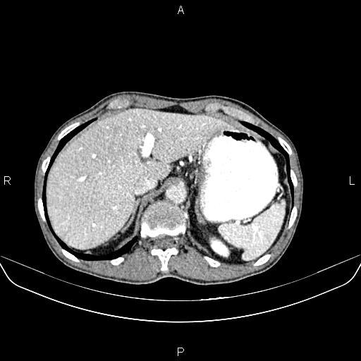Colon adenocarcinoma - hepatic flexure (Radiopaedia 85635-101395 A 20).jpg