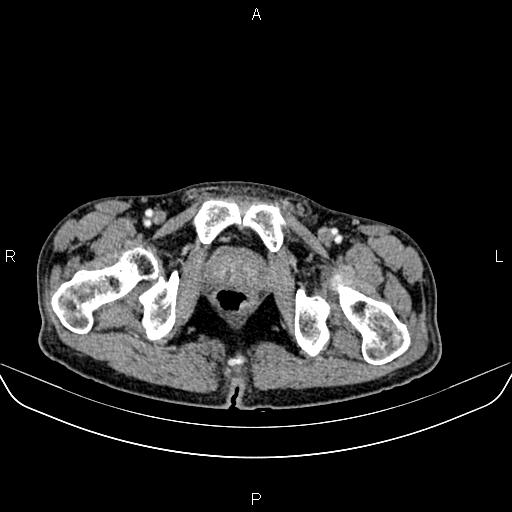 Colon adenocarcinoma - hepatic flexure (Radiopaedia 85635-101395 A 98).jpg