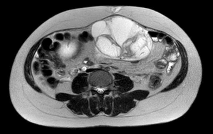 Colon adenocarcinoma with Krukenberg tumors, advanced pregnancy (Radiopaedia 67279-76645 Axial T2 37).jpg