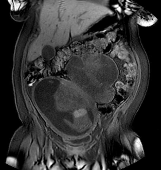 Colon adenocarcinoma with Krukenberg tumors, advanced pregnancy (Radiopaedia 67279-76645 E 25).jpg
