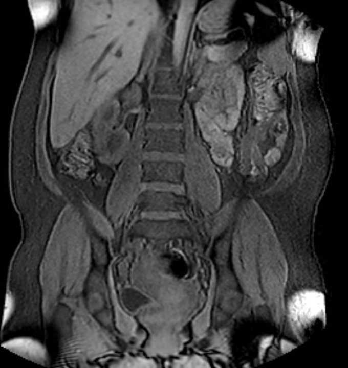 Colon adenocarcinoma with Krukenberg tumors, advanced pregnancy (Radiopaedia 67279-76645 E 58).jpg