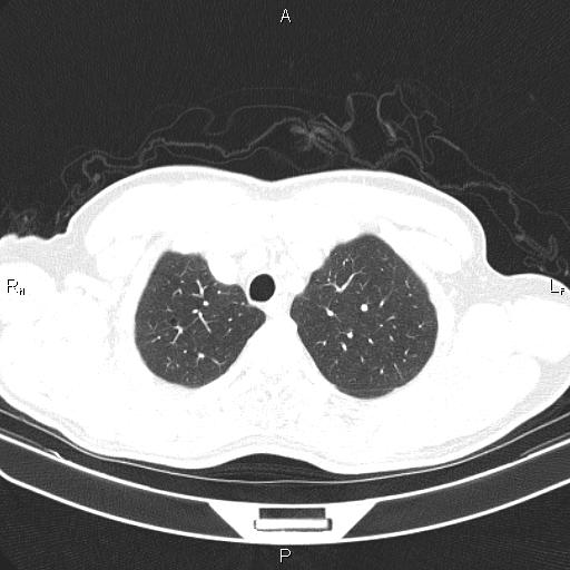 File:Colon cancer (Radiopaedia 85663-101443 Axial lung window 11).jpg