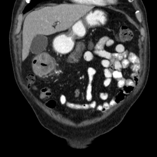 File:Colon cancer with duodenal invasion (Radiopaedia 16278-15958 B 14).jpg