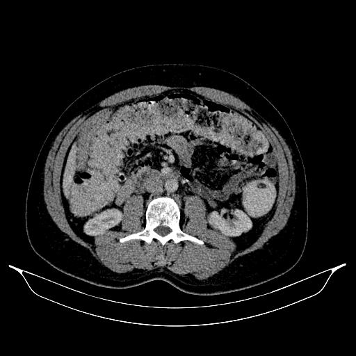 Colonic diverticulosis (Radiopaedia 72222-82744 A 1).jpg