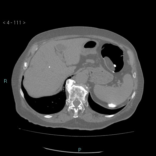 File:Colonic lipomas (Radiopaedia 49137-54244 Axial bone window 49).jpg