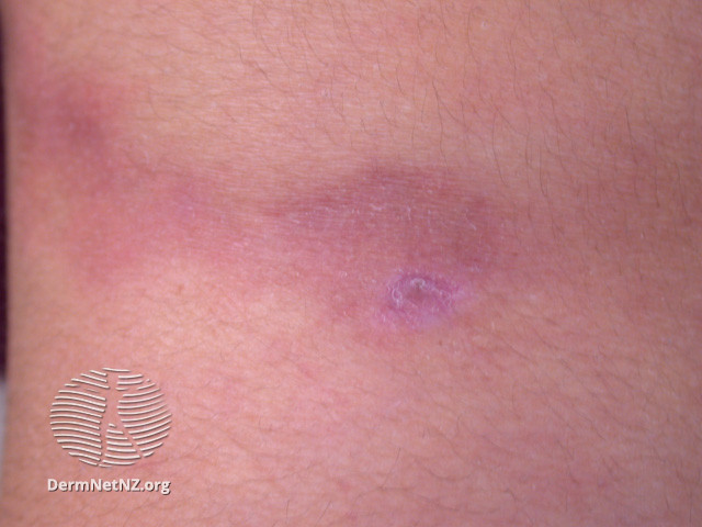 File:Lupus panniculitis (DermNet NZ immune-lupus-pann).jpg