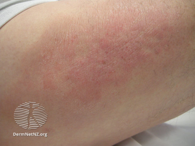 File:Meralgia paraesthetica (DermNet NZ meralgia-paraesthetica2).jpg