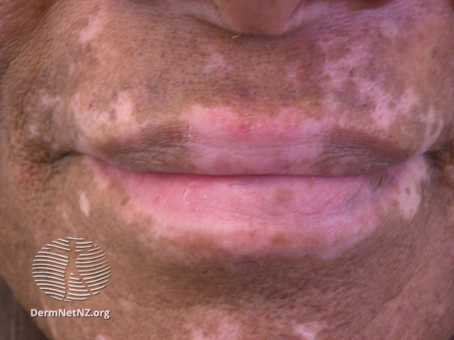 File:Mucosal vitiligo (DermNet NZ colour-vitiligo4).jpg
