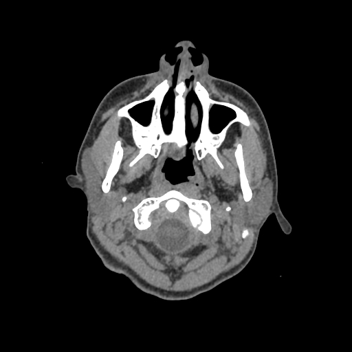Nasal pyogenic granuloma (lobular capillary hemangioma) (Radiopaedia 85536-101244 Axial non-contrast 8).jpg