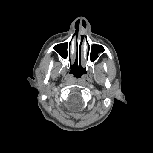 Nasal pyogenic granuloma (lobular capillary hemangioma) (Radiopaedia 85536-101244 C 28).jpg