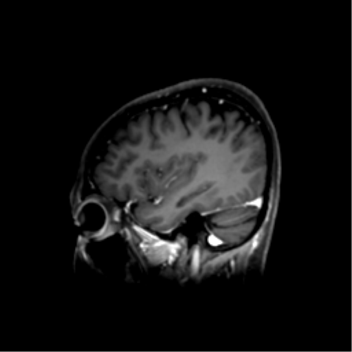 File:Nasopharyngeal carcinoma with cerebral abscess (Radiopaedia 43018-46274 J 41).png