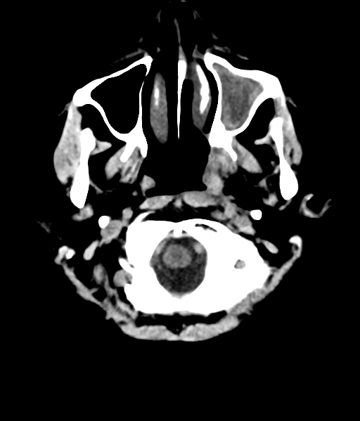 File:Nasopharyngeal carcinoma with cerebral abscess (Radiopaedia 43018-46275 Axial non-contrast 7).png
