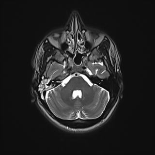 Nasopharyngeal carcinoma with perineural spread (Radiopaedia 55030-61380 Axial T2 20).jpg