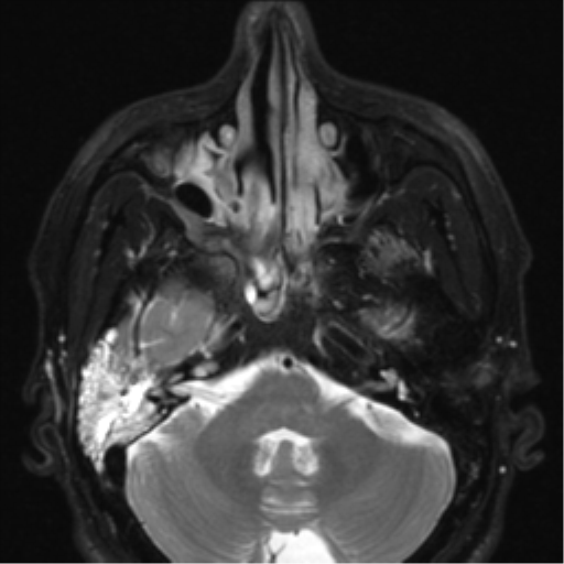 File:Nasopharyngeal carcinoma with pterygopalatine fossa involvement (Radiopaedia 33102-34134 Axial T2 20).png