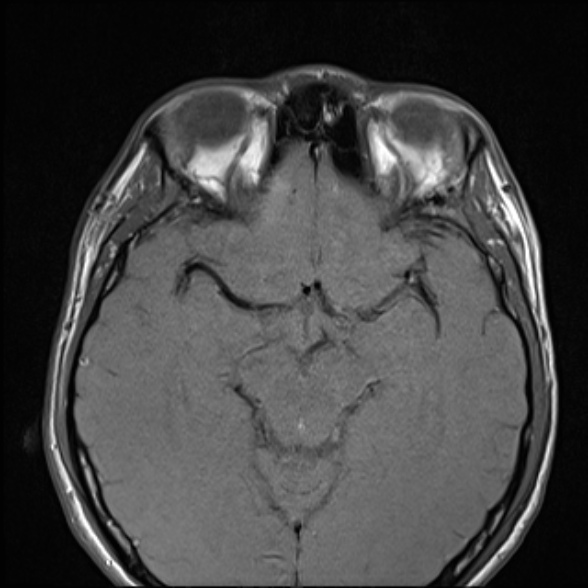 Nasopharyngeal carcinoma with skull base invasion (Radiopaedia 53415-59485 Axial T1 13).jpg