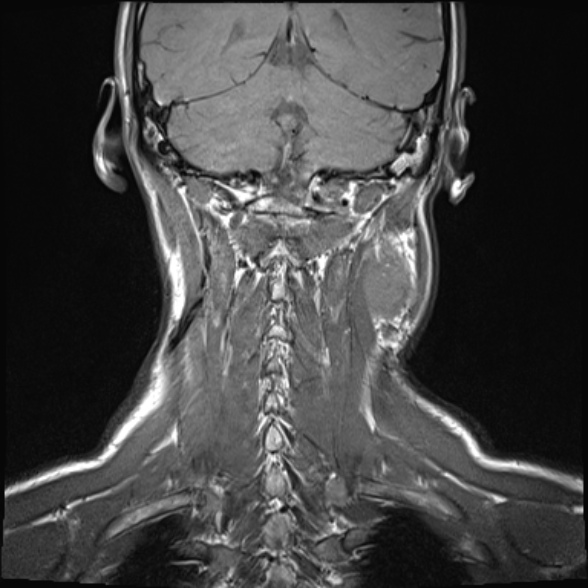 Nasopharyngeal carcinoma with skull base invasion (Radiopaedia 53415-59485 Coronal T1 5).jpg