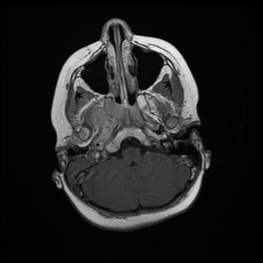 File:Nasopharyngeal rhabdomyosarcoma (Radiopaedia 23417-23486 Axial T1 C+ 6).jpg