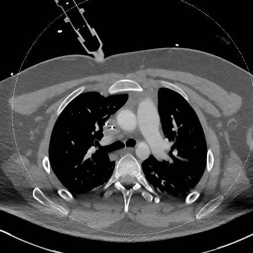 File:Neck CT angiogram (intraosseous vascular access) (Radiopaedia 55481-61945 B 40).jpg