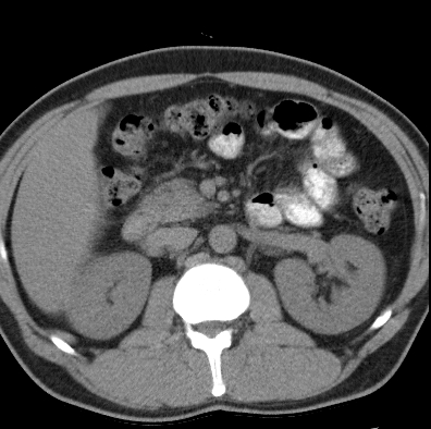 File:Necrotizing pancreatitis with acute necrotic collection (Radiopaedia 14470-14417 Axial non-contrast 17).jpg