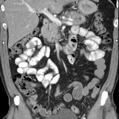 File:Necrotizing pancreatitis with acute necrotic collection (Radiopaedia 14470-14417 C 16).jpg