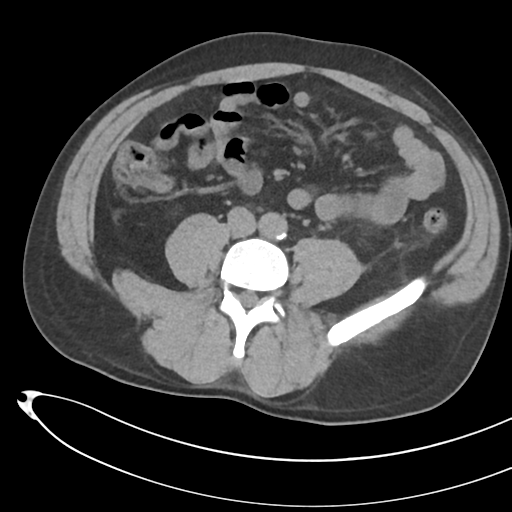 File:Necrotizing pancreatitis with acute necrotic collections (Radiopaedia 38829-41012 Axial non-contrast 50).png