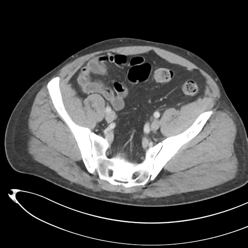 File:Necrotizing pancreatitis with acute necrotic collections (Radiopaedia 38829-41012 B 66).png