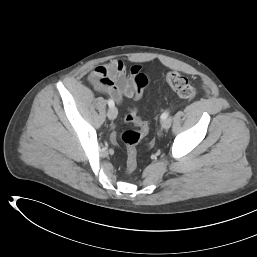 File:Necrotizing pancreatitis with acute necrotic collections (Radiopaedia 38829-41012 B 70).png