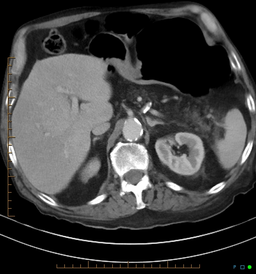 Necrotzing fasciitis due to a perforated adenocarcinoma of the splenic flexure (Radiopaedia 46930-51455 A 23).jpg