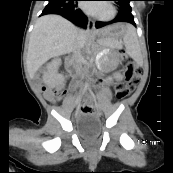 File:Neonatal neuroblastoma (Radiopaedia 56651-63438 Coronal non-contrast 29).jpg