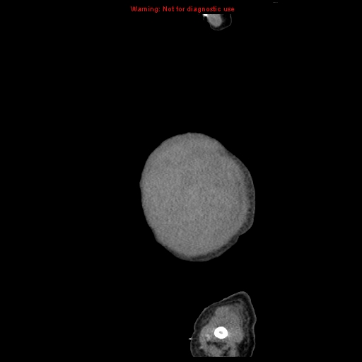 File:Neonatal neuroblastoma (Radiopaedia 9564-10223 C 7).jpg