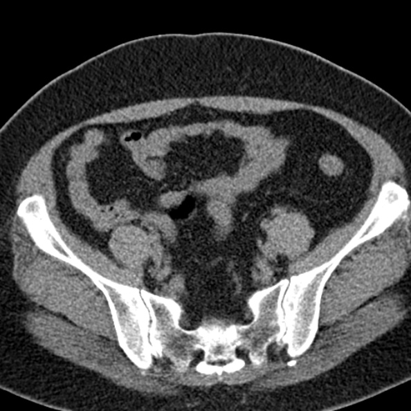 File:Nephrostomy for urosepsis (Radiopaedia 26180-26330 Axial non-contrast 49).jpg