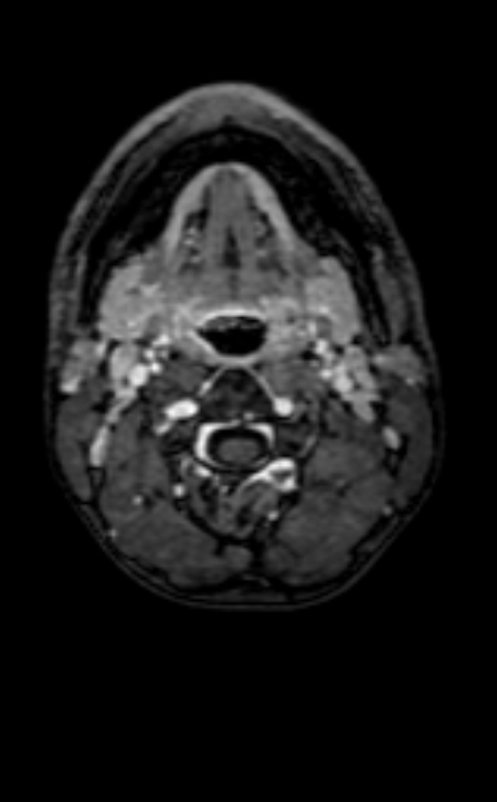 Neuro-Behçet disease (Radiopaedia 90112-107294 Axial T1 C+ 245).jpg