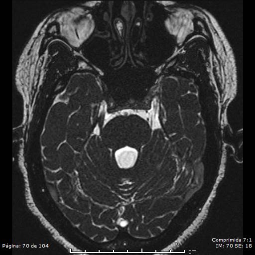 Neurocysticercosis (Radiopaedia 58636-65832 I 70).jpg