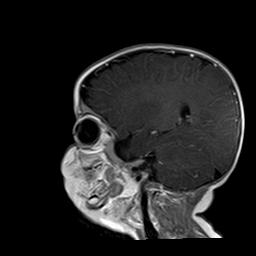 File:Neurofibromatosis type 1 (Radiopaedia 30089-30671 Sagittal T1 C+ 4).jpg