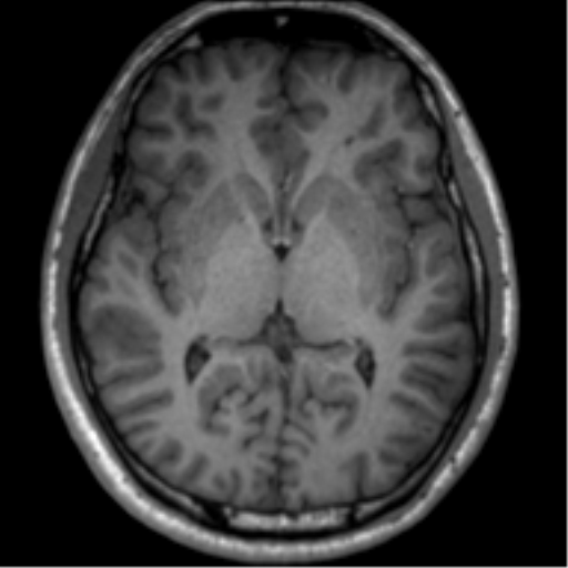 File:Neurofibromatosis type 2 (Radiopaedia 44936-48838 Axial T1 73).png