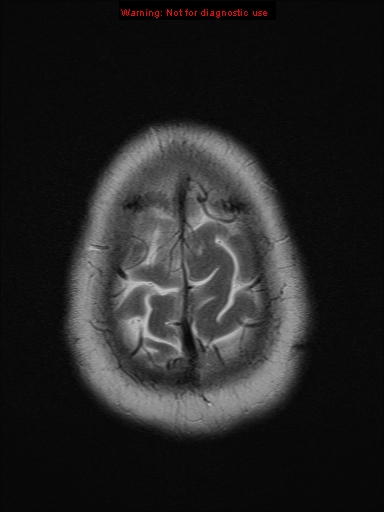 File:Neuroglial cyst (Radiopaedia 10713-11184 Axial T2 2).jpg