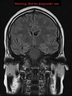 File:Neuroglial cyst (Radiopaedia 10713-11184 Coronal FLAIR 14).jpg