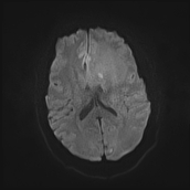 File:Neurotoxoplasmosis - concentric target sign (Radiopaedia 70644-80784 Axial DWI 13).jpg