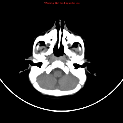 File:Non-accidental injury - bilateral subdural with acute blood (Radiopaedia 10236-10765 Axial non-contrast 3).jpg